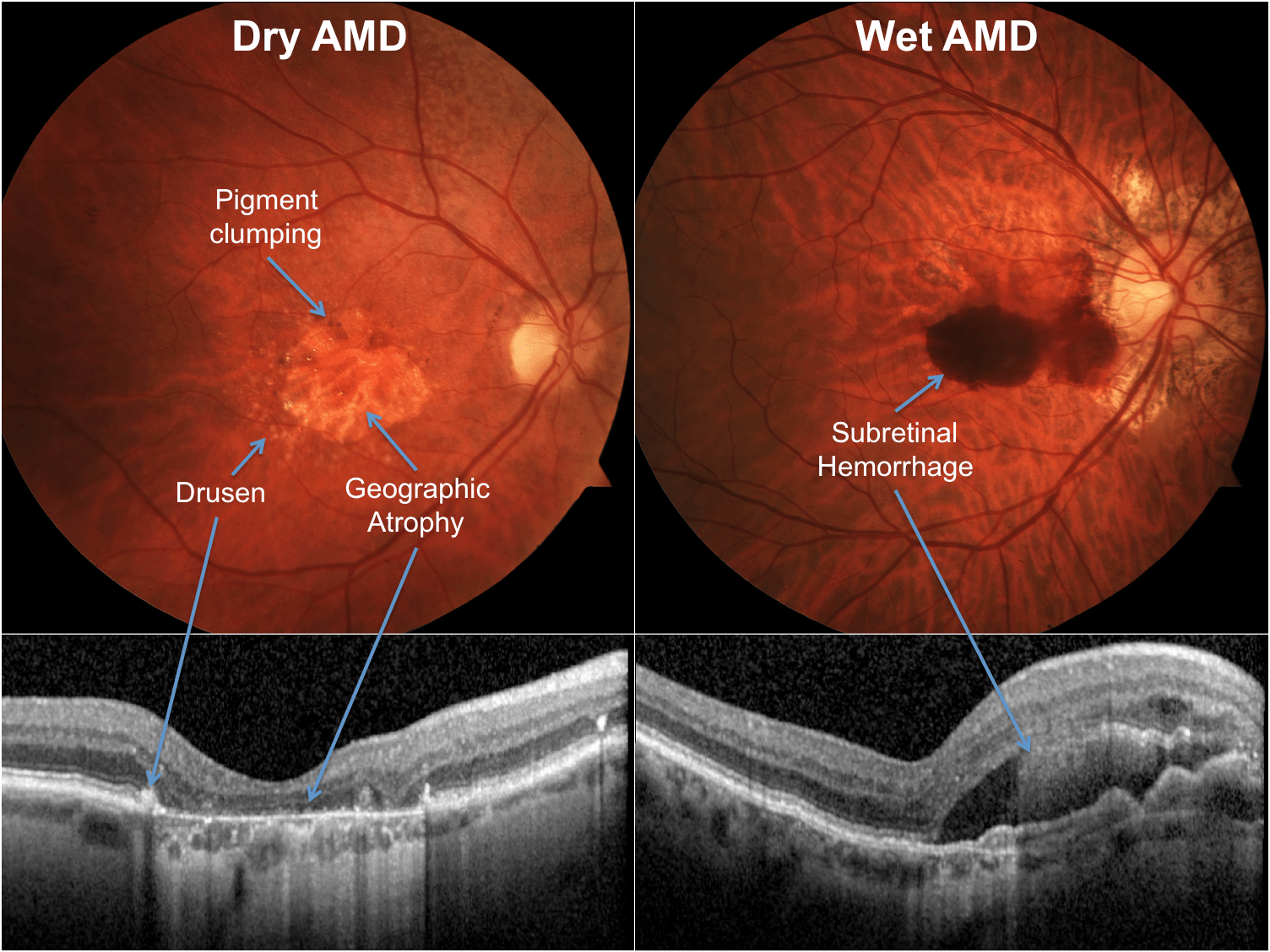 Lets talk about Macular degeneration 