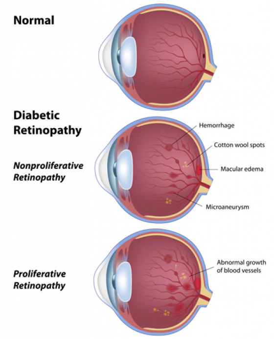 November: Diabetic Eye Disease month, what you need to know. 