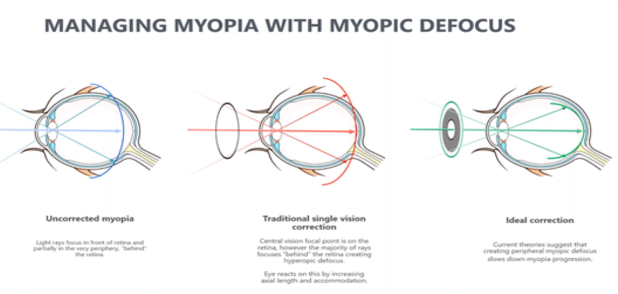 We need to talk about Myopia; Myopia Management. 